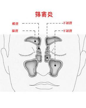 筛窦炎 - 搜狗百科
