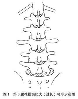 第3腰椎横突过长畸形 搜狗百科