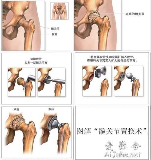 髋关节置换 搜狗百科