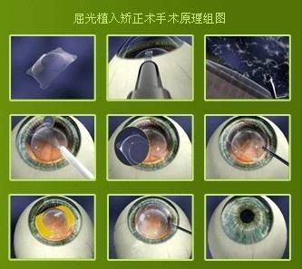 Icl手术 搜狗百科 Icl手术 搜狗百科