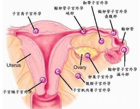 宫外孕流产 搜狗百科 宫外孕流产 搜狗百科