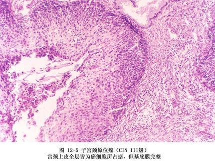 子宫颈原位癌 搜狗百科