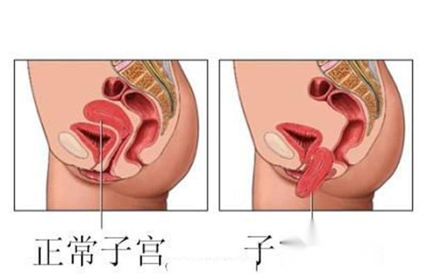 子宫脱出 搜狗百科