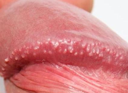 阴茎珍珠样丘疹病 搜狗百科