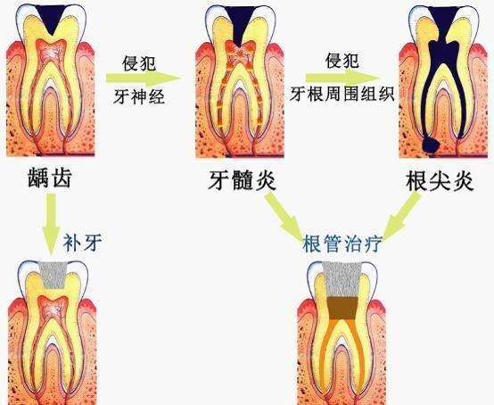 急性牙髓炎 搜狗百科