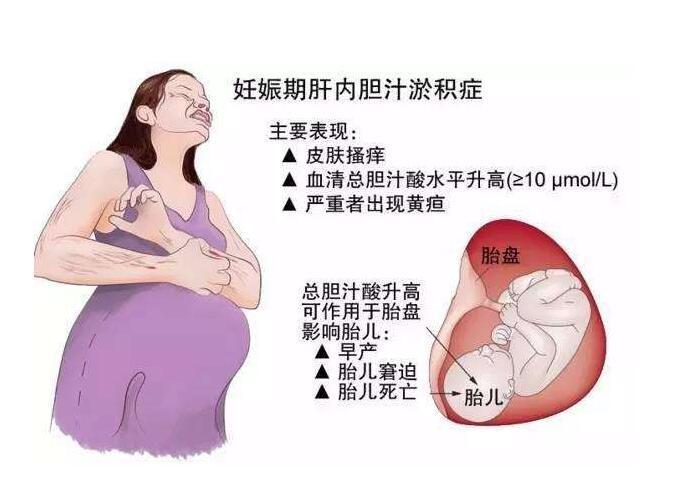 胆汁淤积症