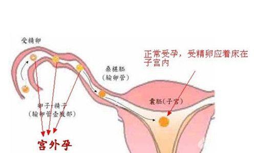 宫外孕怎么办 搜狗百科