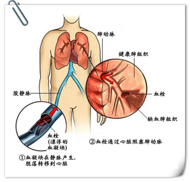 低氧血症 搜狗百科