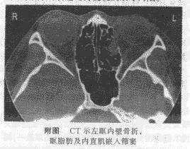筛窦骨折 搜狗百科