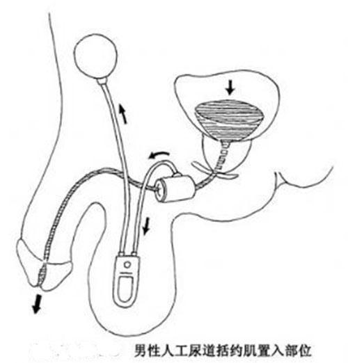 人工尿道