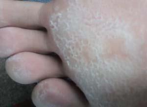 足底脱皮 搜狗百科