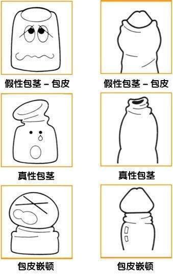 假性包茎 搜狗百科 假性包茎 搜狗百科