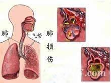 肺爆震伤 搜狗百科 肺爆震伤 搜狗百科