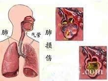 肺爆震伤 搜狗百科