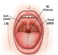 扁桃腺结石 搜狗百科