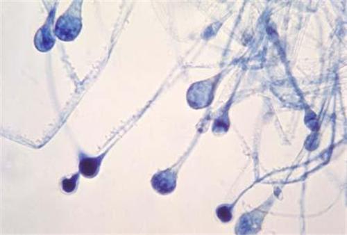 毛霉菌病 感染性疾病 搜狗百科