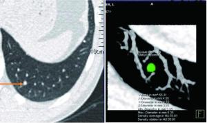 肺结节的容积测量