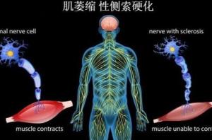 肌肉萎缩性侧索硬化症