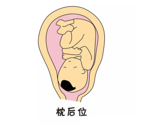枕后位 - 搜狗百科