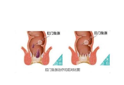 肛门下坠