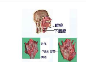 咽喉癌