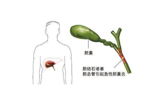 急性胆囊炎