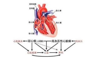 心源性心脏病