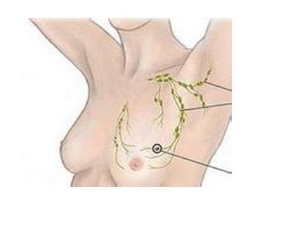 乳腺癌的远处转移