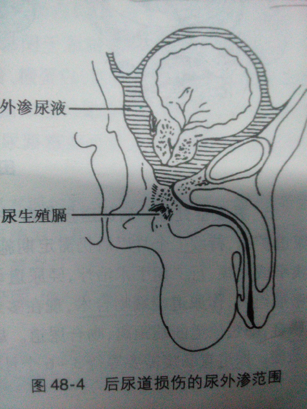 后尿道断裂