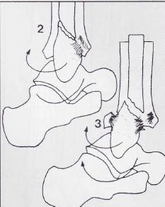 螺旋形骨折