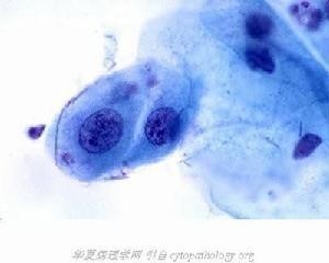 肠上皮化生