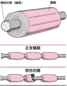 脱髓鞘病变 搜狗百科