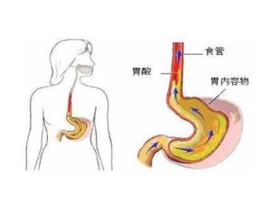 聲嘶,咽部不適,異物感主要症狀食管抗反流屏障,食管酸清除,食管黏膜
