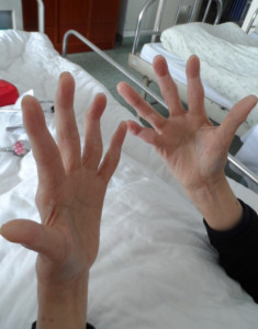 爪形手尺神经在 臂部损伤时,主要表现为屈腕能力减弱,屈4,5指的远节指