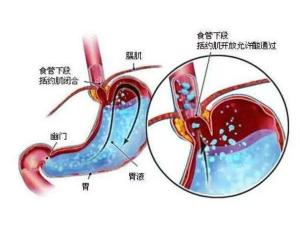 胃食管反流