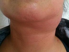 颈下淋巴结肿大