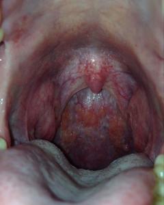 咽后壁淋巴滤泡增生