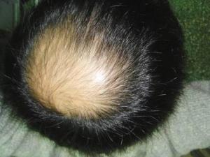 永久性脱发,表现为头顶部扩散性脱发,可以清楚地看到头皮,头发变得