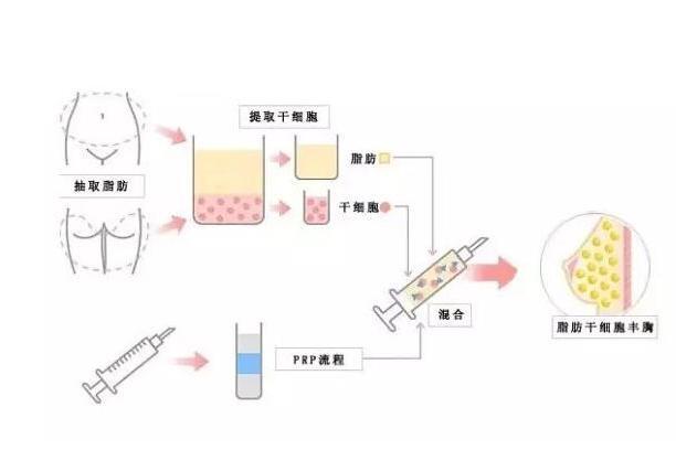 自体移植_搜狗百科