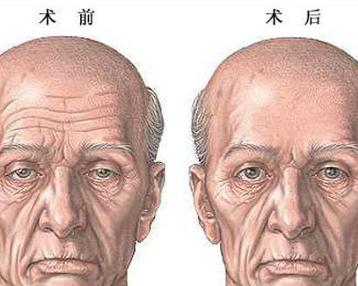 额颞部皮肤提紧术 - 搜狗百科