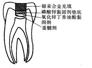 间接盖髓术
