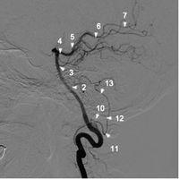 椎动脉造影2