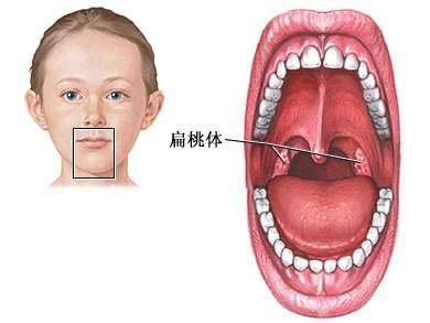 腭扁桃体溃疡图片图片