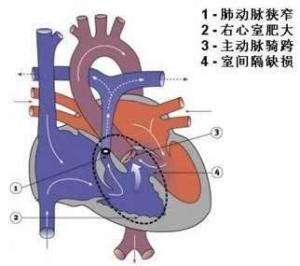 肺动脉口狭窄指右心室漏斗部,肺动脉瓣或肺动脉总干及其分支等处的