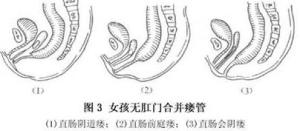 先天性肛门直肠畸形