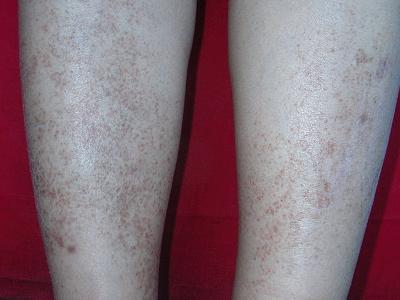 进行性色素性紫癜性皮病 - 搜狗百科