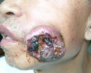 咬颊症口腔癌图片