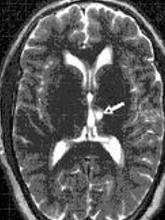 免疫球蛋白过高是什么导致的 0