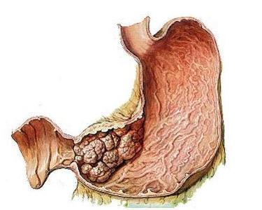 胃间质瘤