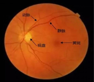 眼底血管样条纹